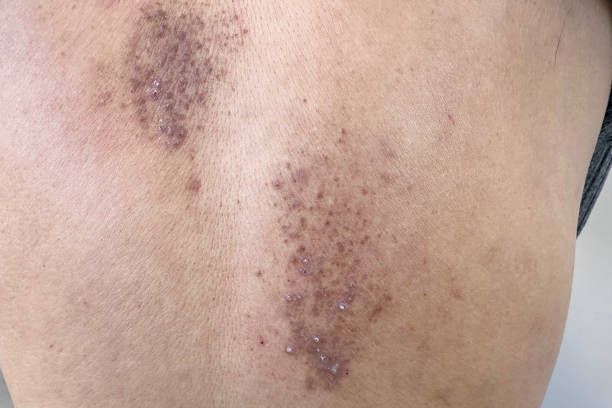 Αμυλοείδωση, η ύπουλη νόσος με τα πολλά πρόσωπα