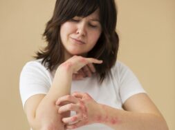 hands-patient-suffering-from-psoriasis