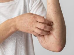 skin-allergy-reaction-person-s-arm
