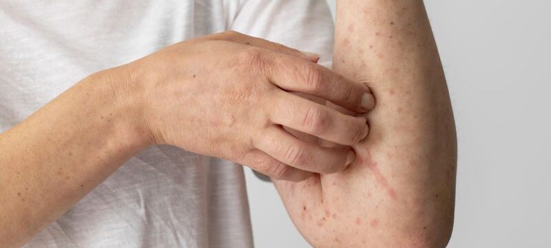 skin-allergy-reaction-person-s-arm