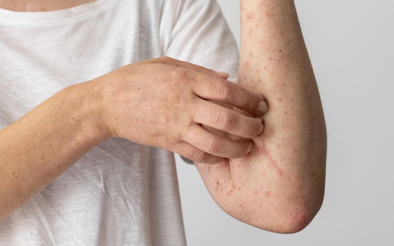 Γιατί παρατηρείται αύξηση κρουσμάτων έρπητα ζωστήρα;