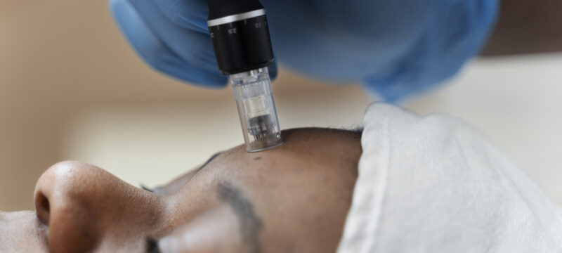 person-getting-micro-needling-beauty-treatment