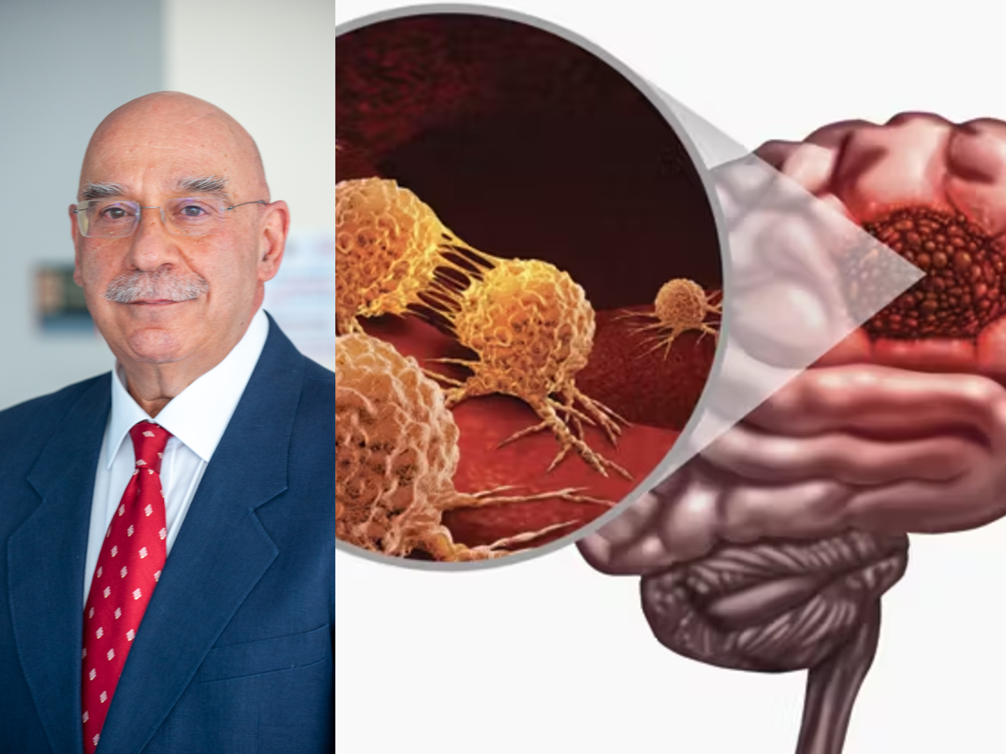 Πολύμορφο γλοιοβλάστωμα: Η ελπίδα μέσα από τα λόγια του Χρ. Γεωργόπουλου