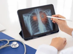 lung-cancer-pneumonia-emphysema-concept-600nw-2521690839