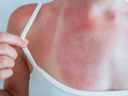 swimsuit-strap-marks-on-young-woman-s-sunburned-sk-2023-06-17-03-49-20-utc