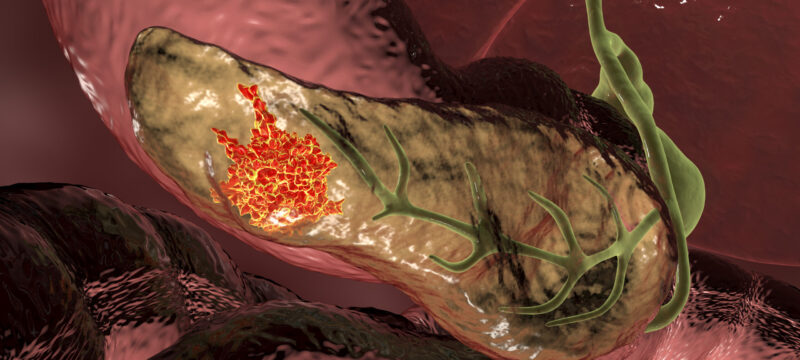 Aug21_2020_Getty_1215121154_PancreaticCancer-scaled