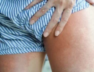 close-allergy-rash-round-view-260nw-2188897349