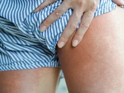 close-allergy-rash-round-view-260nw-2188897349