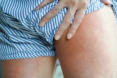 Σπυράκια με υγρό στον εσωτερικό μηρό: Οδηγός πρόληψης και φροντίδας