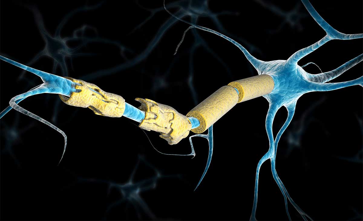 Πρώιμα σημάδια σκλήρυνσης κατά πλάκας εντοπίζονται δεκαετίες πριν τη διάγνωση