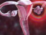 Polycystic_Ovary_Syndrome_Promo_PE_1796x943