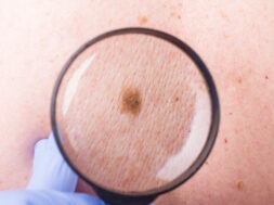 the doctor examines the birthmarks on the man’s body