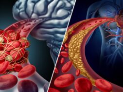 Brain-Stroke-Vs-Heart-Stroke