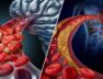 Brain-Stroke-Vs-Heart-Stroke