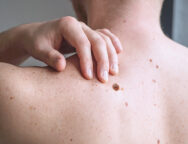 Checking benign moles. Close up detail of the bare skin on a man