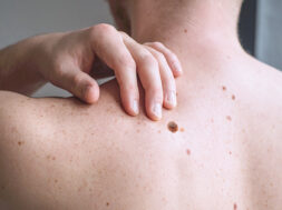 Checking benign moles. Close up detail of the bare skin on a man