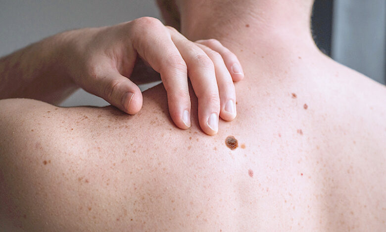 Checking benign moles. Close up detail of the bare skin on a man