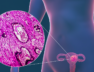 Uterine-Cancer-Illustrated-Feature-DTM