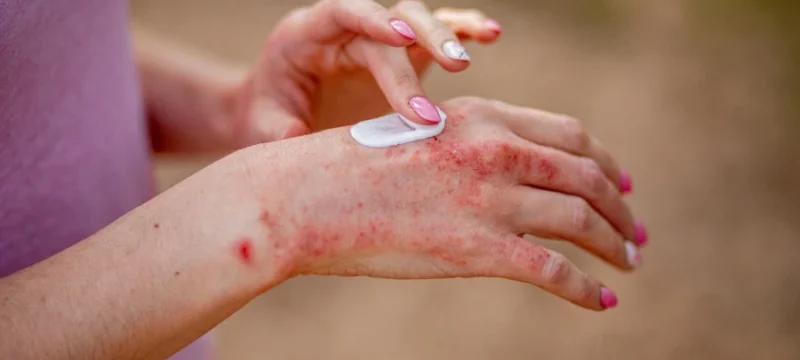 bigstock-Eczema-On-The-Hands-The-Woman-451343859