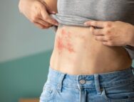 Woman,With,Shingles,On,The,Skin,She,Feels,Very,Painful
