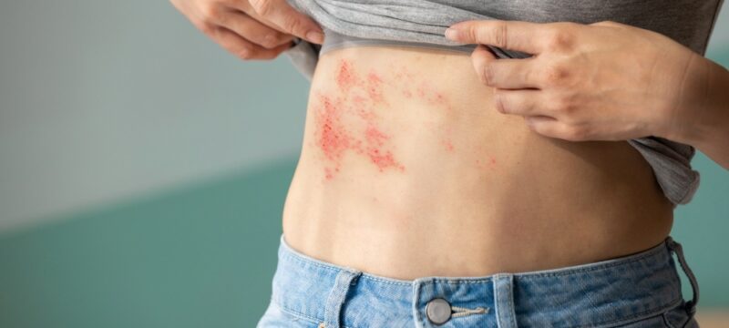 Woman,With,Shingles,On,The,Skin,She,Feels,Very,Painful