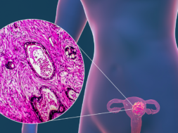 Uterine-Cancer-Illustrated-Feature-DTM (1)
