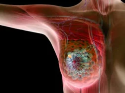 princ_rf_photo_of_breast_cancer_illustration