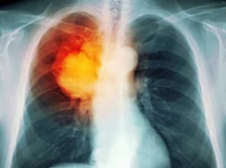 princ_rm_photo_of_lung_cancer_xray