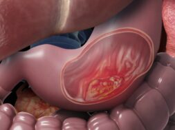 stomachcancer_1280
