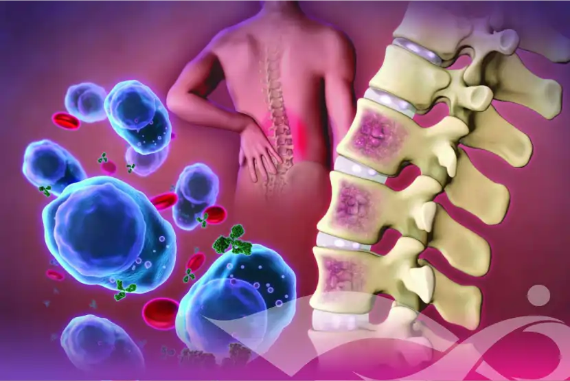 Η αξία της έγκαιρης διάγνωσης στο Πολλαπλούν Μυέλωμα – Μήνας δράσεων ο Μάρτιος