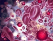 monoclonal gammopathy of undetermined significance (MGUS) and its importance to monitor it – virginia oncology associates