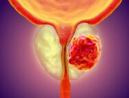 prostate-cancer