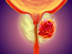 prostate-cancer