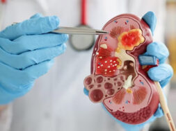 Main-urinarybladdercancer