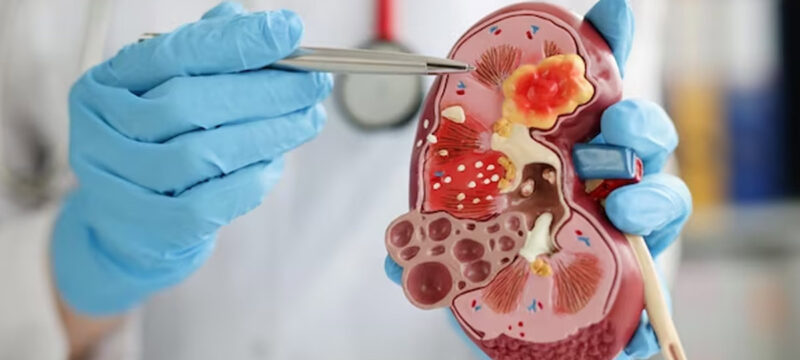 Main-urinarybladdercancer