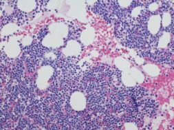 multiple-myeloma