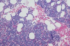 multiple-myeloma