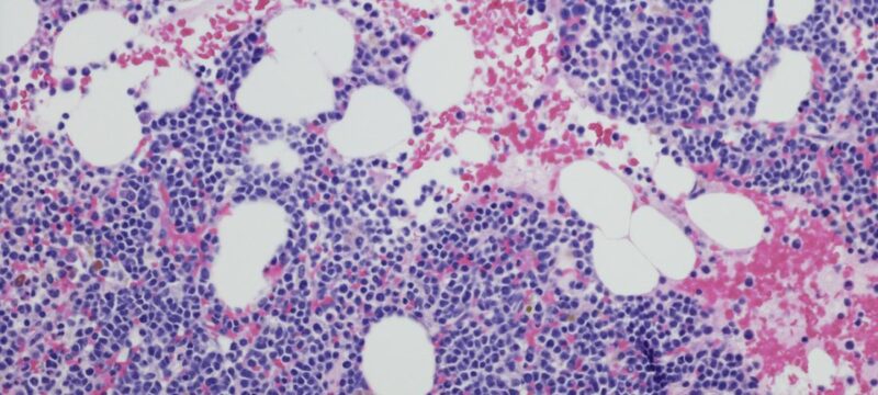 multiple-myeloma