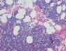 multiple-myeloma