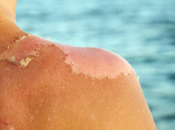 Skin peeling