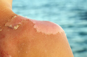 Skin peeling