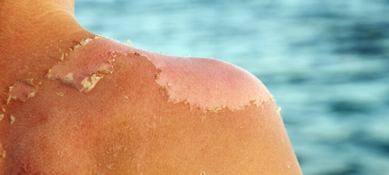 Skin peeling