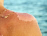 Skin peeling
